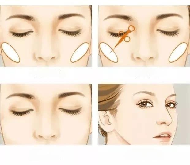 Hyaluronic Acid Facial Injection Techniques And Skills