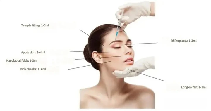 A brief introduction to the application of hyaluronic acid (HA) filling injection in medical beauty (2)