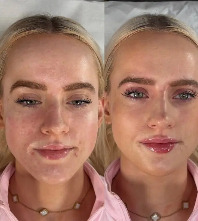 best place for fillers